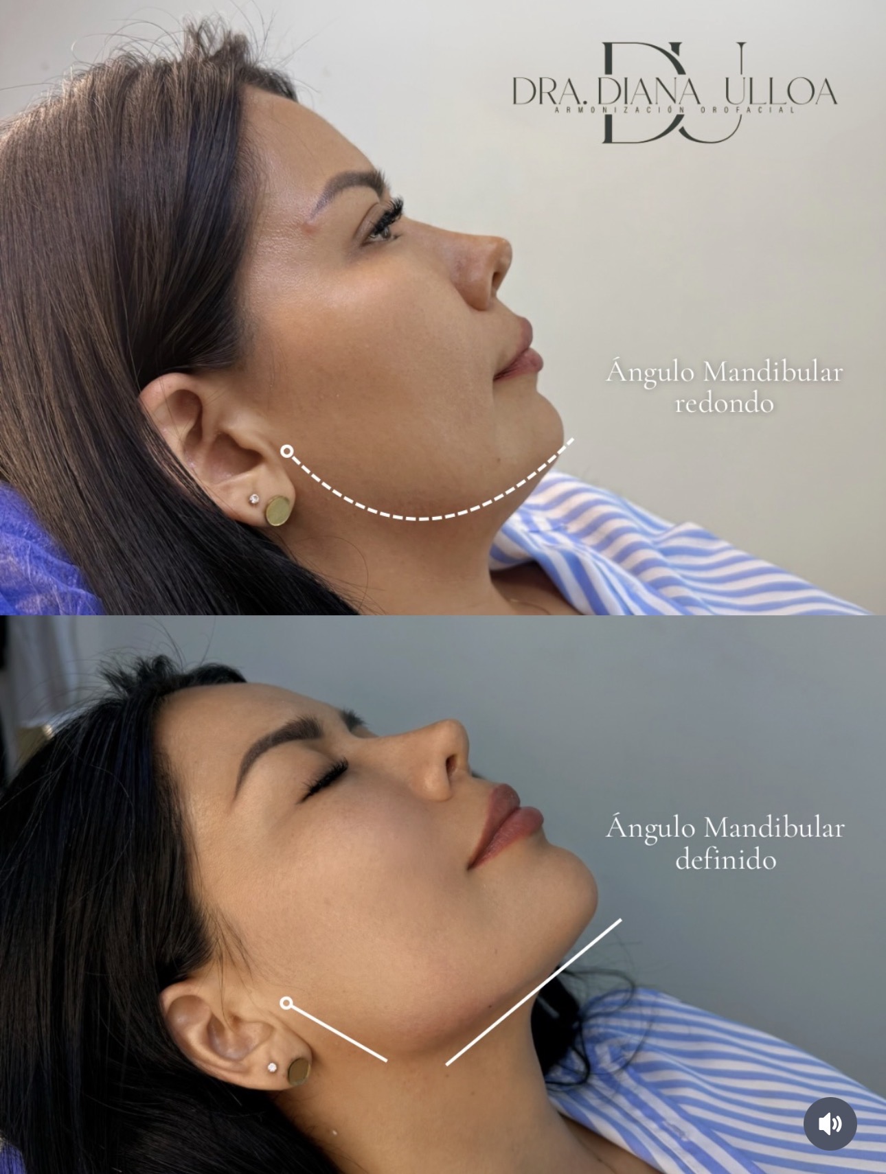 Definición mandibular
