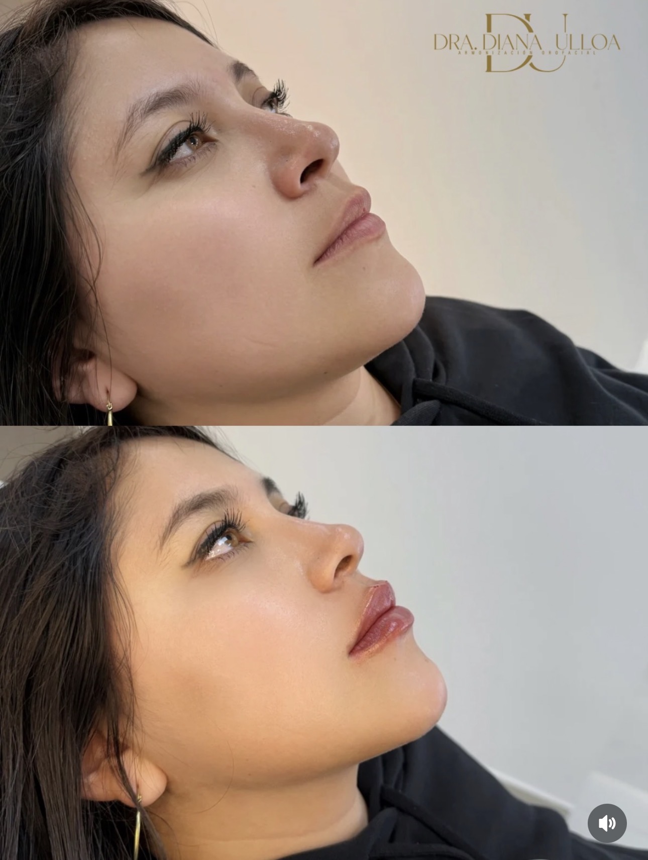 Proyección labial y perfil