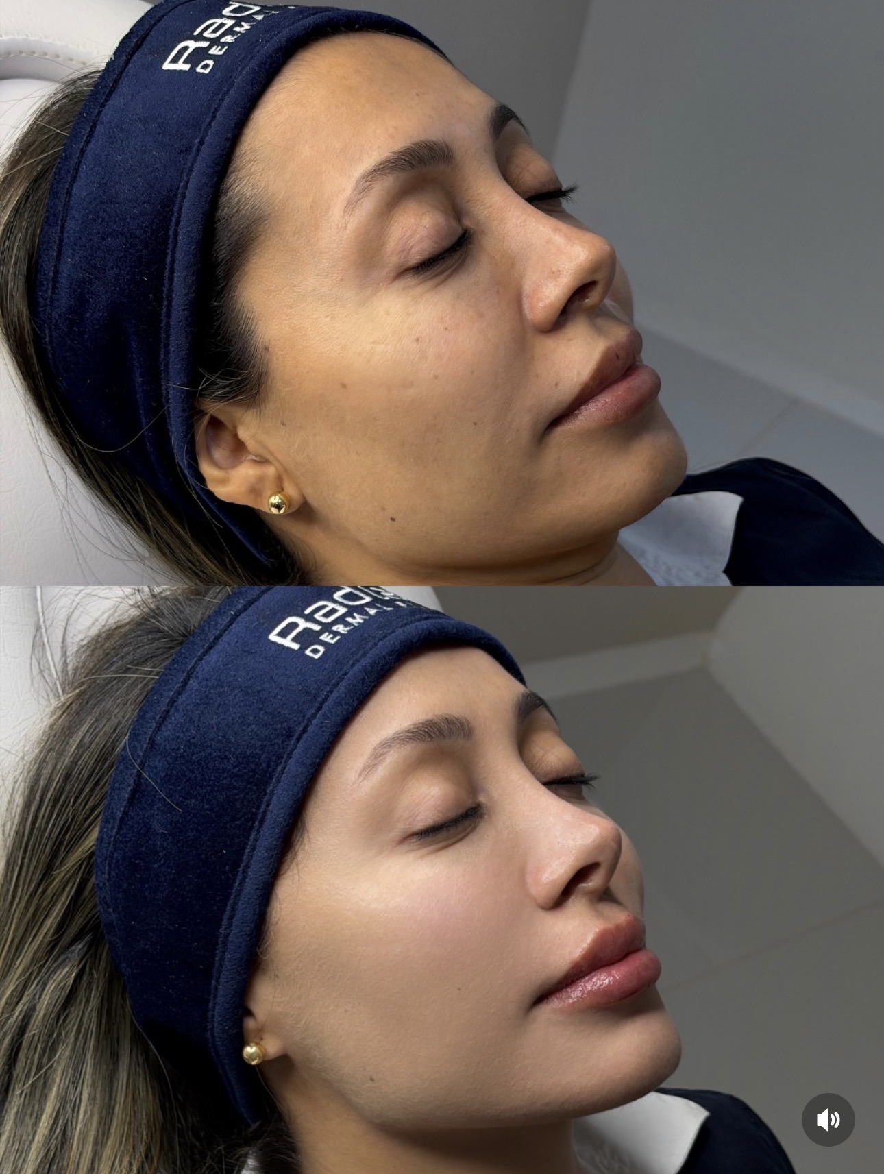Contorno mandibular