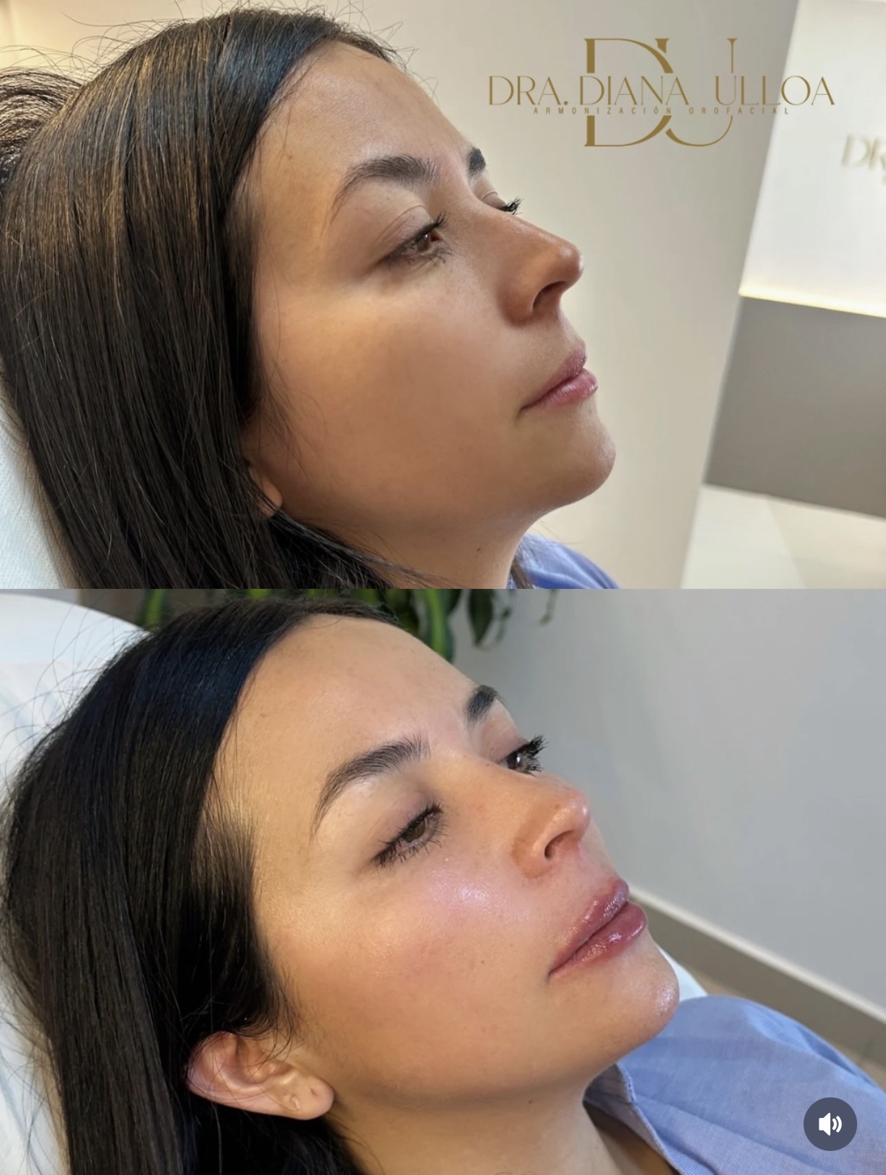 Rejuvenecimiento facial